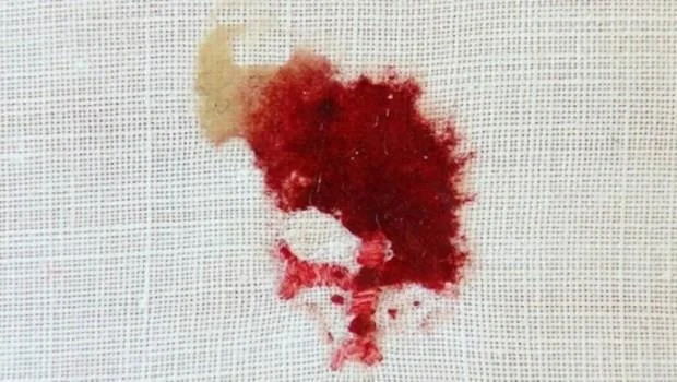 Eucharistic miracle — blood on corporal cloth.